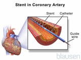 Percutaneous coronary intervention (PCI)