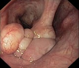 Benign Laryngeal Tumors