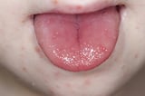 Hand-Foot-and-Mouth Disease (HFMD)