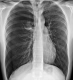 Causes of Secondary Spontaneous Pneumothorax