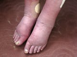 Some Causes of Edema