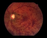 Central Retinal Vein Occlusion and Branch Retinal Vein Occlusion