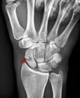 Scaphoid (Navicular) Fractures