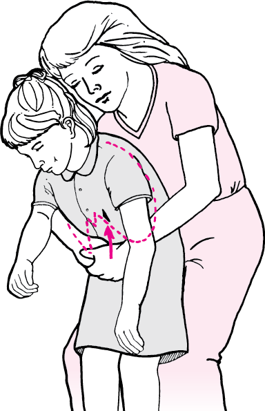 Abdominal thrusts with victim standing or sitting (conscious)