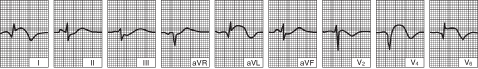 Lateral left ventricular infarction (after the first 24 hours)