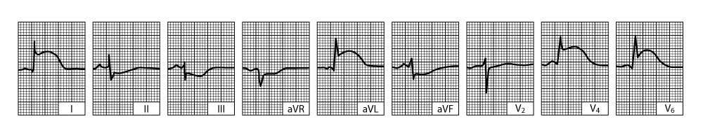 Acute lateral left ventricular infarction (tracing obtained within a few hours of onset of illness)
