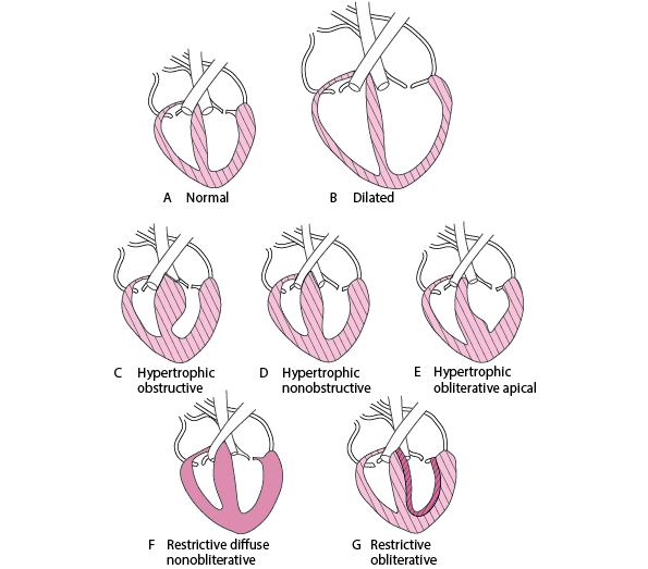 Forms of Cardiomyopathy