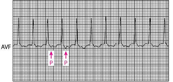 Narrow QRS tachycardia: Orthodromic reciprocating tachycardia using an accessory pathway in Wolff-Parkinson-White syndrome