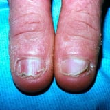 Nail deformities and dystrophies associated with systemic problems