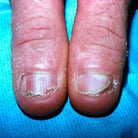 Nail Deformities and Dystrophies