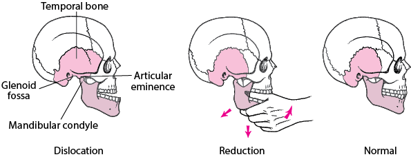 Mandibular reduction