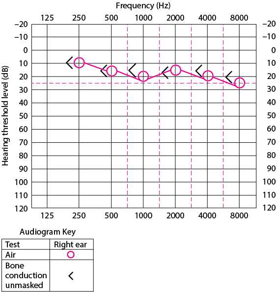 Audiogram of right ear in a patient with normal hearing