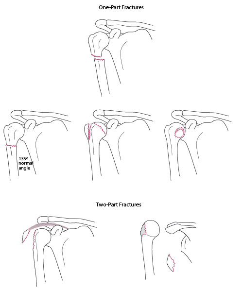 One- and 2-part fractures of the proximal humerus