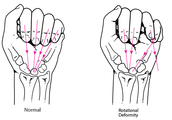 Rotational deformity due to a fracture in the hand