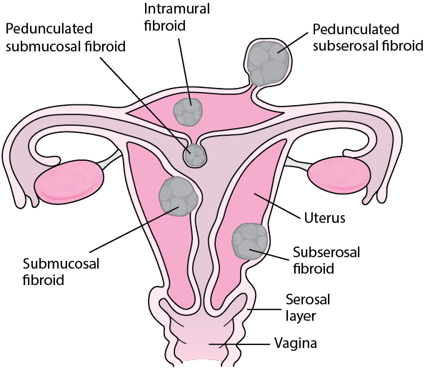 Anatomic locations of uterine fibroids