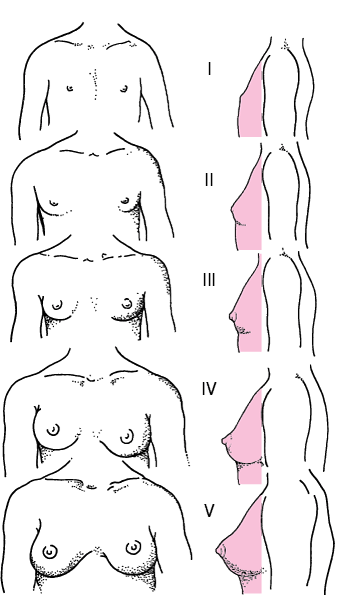 Diagrammatic representation of Tanner stages I to V of breast maturation in girls