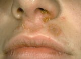 Staphylococcal skin infections
