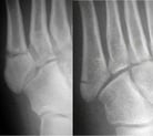 Fractures of the 5th Metatarsal Bone