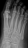 Fracture of the 2nd metatarsal base with tarsometatarsal joint dislocation