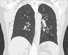 Lymphocytic Interstitial Pneumonia