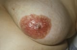 Paget Disease of the Nipple