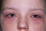Allergic Conjunctivitis