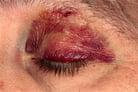 Eye Contusions and Lacerations