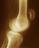 Knee Extensor Mechanism Injuries