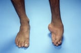Talipes Equinovarus (Clubfoot) and Other Foot Abnormalities