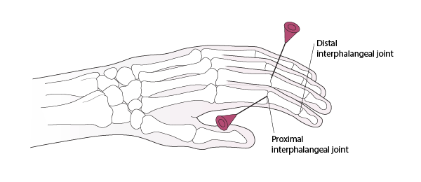 Arthrocentesis of the Proximal Interphalangeal Joint