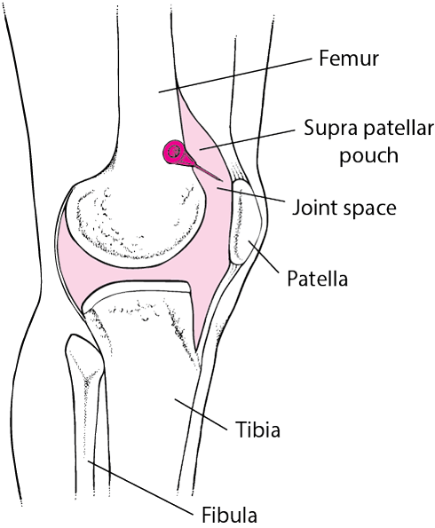 Arthrocentesis of the knee