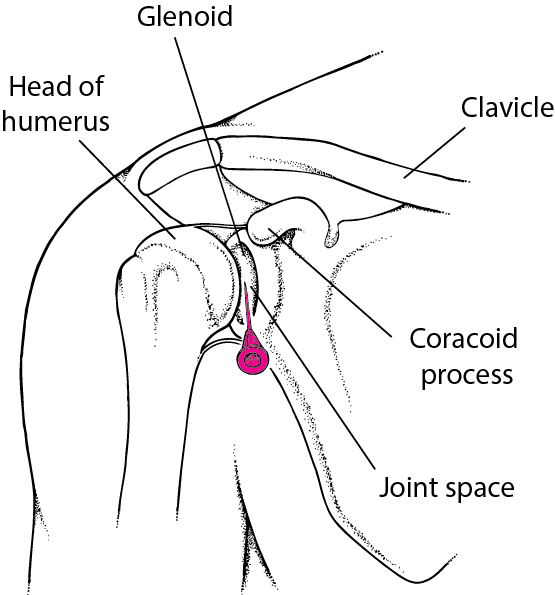 Arthrocentesis of the shoulder