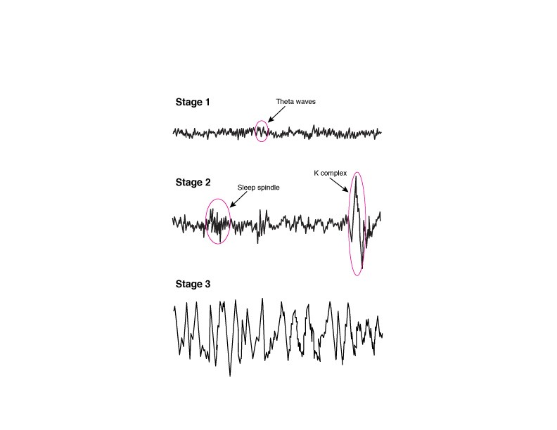 Nonrapid eye movement (NREM) EEG