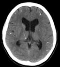 Helminthic Brain Infections