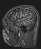 Magnetic Resonance Imaging (MRI) in Neurologic Disorders