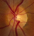 Primary Open-Angle Glaucoma