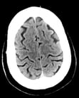 Computed Tomography (CT) in Neurologic Disorders