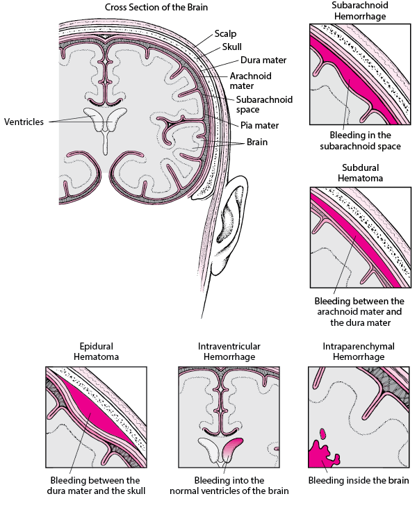Types of intracranial hemorrhage