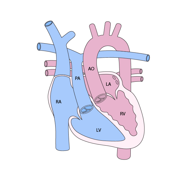 Congenitally Corrected Transposition of the Great Arteries (CCTGA)
