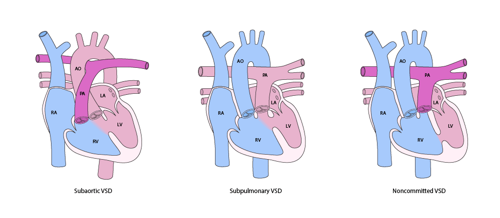Major Variants of Double Outlet Right Ventricle (DORV)
