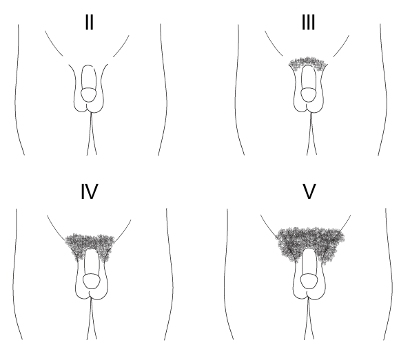 Diagrammatic representation of Tanner stages II to V for development of pubic hair in boys