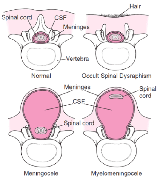 Forms of spina bifida