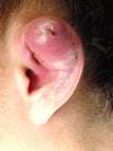 Perichondritis of the Ear