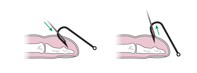 Fish hook removal: Needle cover method