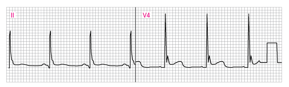 Abnormal ECG showing J (Osborn) waves (V4)