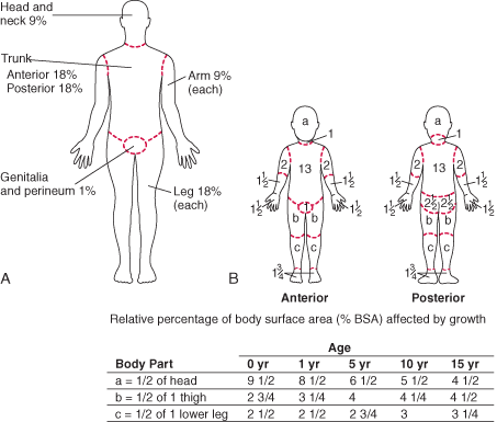 (A) Rule of nines (for adults) and (B) Lund-Browder chart (for children) for estimating extent of burns
