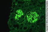 Antiglomerular basement membrane antibody disease