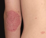 Subtypes of Psoriasis