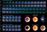 Radionuclide Imaging of the Heart