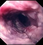 Squamous cell carcinoma of the esophagus reference